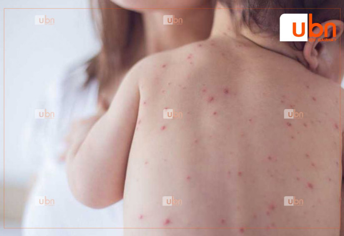 ХӨСҮТ: 7 сартай хүүхэд улаанбурхан өвчний халдвар авсан нь лабораториор батлагдлаа