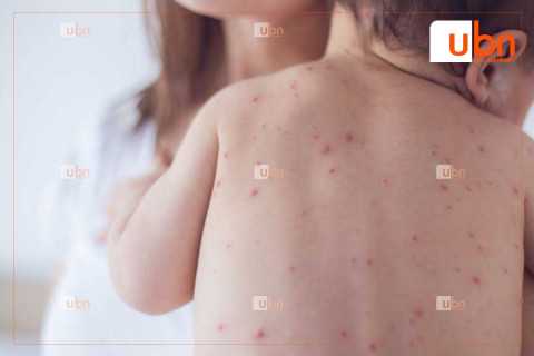 ХӨСҮТ: Сүүлийн 24 цагт улаанбурхан өвчний 23 тохиолдол илэрсний 15 нь орон нутагт байна