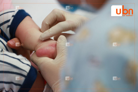 Нэг өдөрт буюу өчигдөр Улаанбурхан өвчний 25 тохиолдол бүртгэгджээ