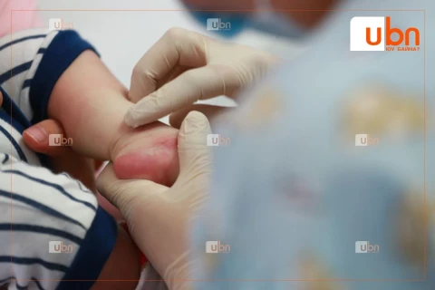 ХӨСҮТ-ийн Эрчимтийн тасагт улаанбурханаар өвчилсөн 6 сартай хүүхэд ХҮНД оноштойгоор эмчлүүлж байна