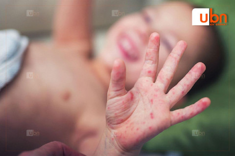 Улаанбурхан өвчний 11 тохиолдол нэмэгджээ